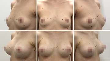 Увеличение грудных желез (маммопластика)