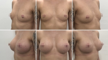 Увеличение грудных желез (маммопластика)