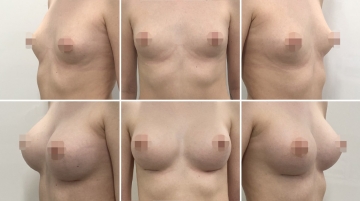 Увеличение грудных желез (маммопластика)
