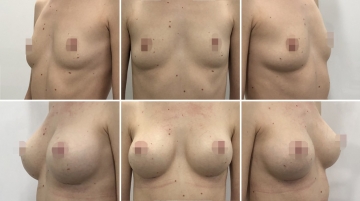 Увеличение грудных желез (маммопластика)