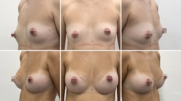 Увеличение грудных желез (маммопластика)