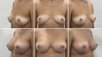 Увеличение грудных желез (маммопластика)