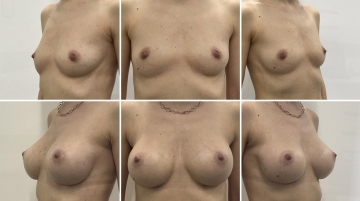 Увеличение грудных желез (маммопластика)