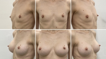 Увеличение грудных желез (маммопластика)
