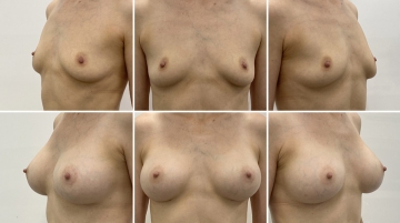 Увеличение грудных желез (маммопластика)