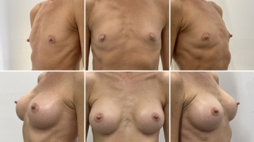 Увеличение грудных желез (маммопластика)