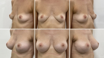 Увеличение грудных желез (маммопластика)