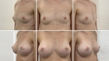Увеличение грудных желез (маммопластика)