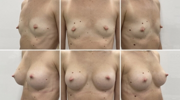 Увеличение грудных желез (маммопластика)