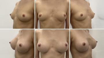 Увеличение грудных желез (маммопластика)