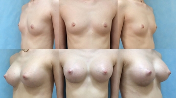 Увеличение грудных желез (маммопластика)