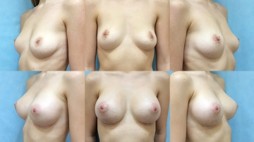 Увеличение грудных желез (маммопластика)