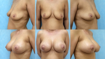 Подтяжка груди с увеличением