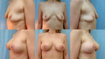 Подтяжка груди с увеличением