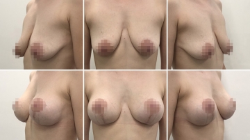 Подтяжка груди с увеличением