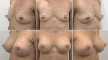 Подтяжка груди с увеличением