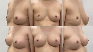 Подтяжка груди с увеличением