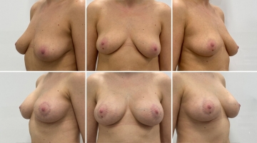 Подтяжка груди с увеличением