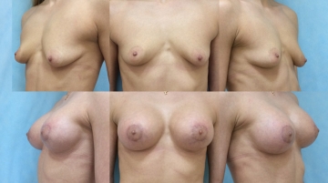 Подтяжка груди с увеличением