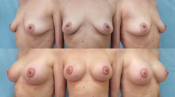 Подтяжка груди с увеличением