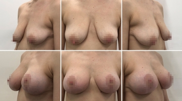 Подтяжка груди с увеличением