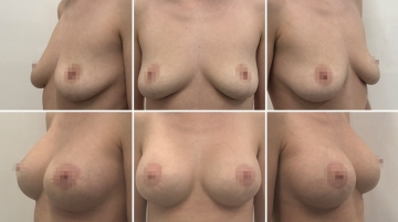 Подтяжка груди с увеличением