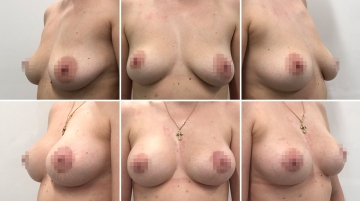 Подтяжка груди с увеличением