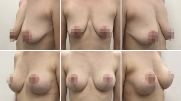 Подтяжка груди с увеличением