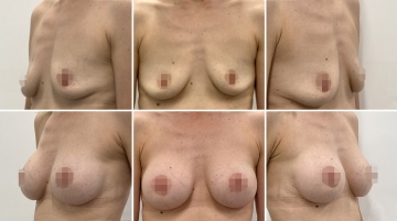 Подтяжка груди с увеличением