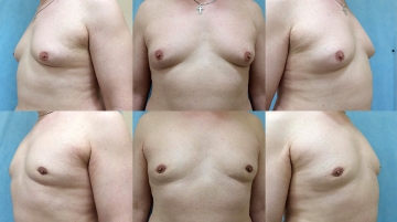 Устранение гинекомастии