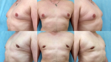 Устранение гинекомастии
