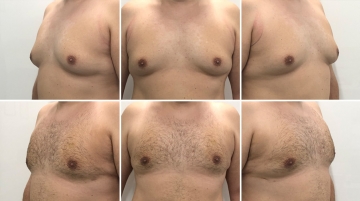 Устранение гинекомастии