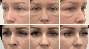 Блефаропластика с подтяжкой средней зоны лица (чек-лифтинг)