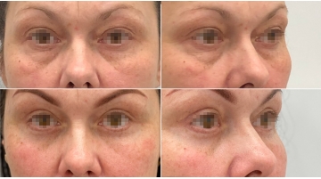 Блефаропластика с подтяжкой средней зоны лица (чек-лифтинг)