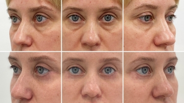 Блефаропластика с подтяжкой средней зоны лица (чек-лифтинг)