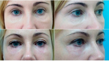 Блефаропластика с подтяжкой средней зоны лица (чек-лифтинг)