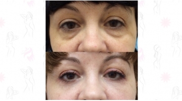 Блефаропластика с подтяжкой средней зоны лица (чек-лифтинг)