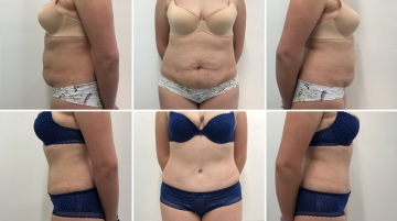 Пластика живота (абдоминопластика)