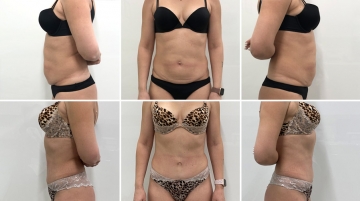 Пластика живота (абдоминопластика)