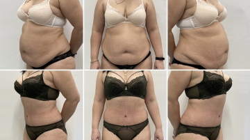 Пластика живота (абдоминопластика)