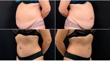 Пластика живота (абдоминопластика)