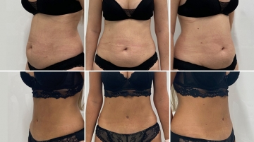 Пластика живота (абдоминопластика)