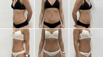 Пластика живота (абдоминопластика)