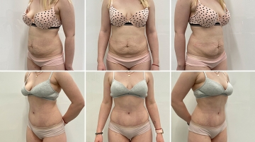 Пластика живота (абдоминопластика)