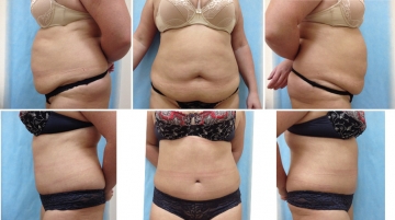 Пластика живота (абдоминопластика)