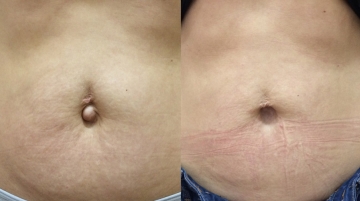 Пластика живота (абдоминопластика)