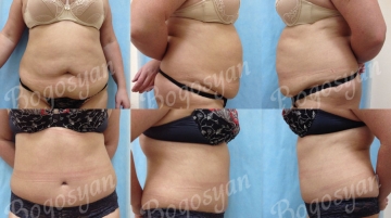 Пластика живота (абдоминопластика)