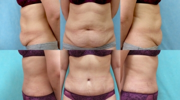 Пластика живота (абдоминопластика)