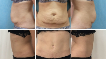 Пластика живота (абдоминопластика)