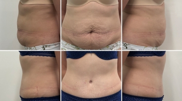 Пластика живота (абдоминопластика)